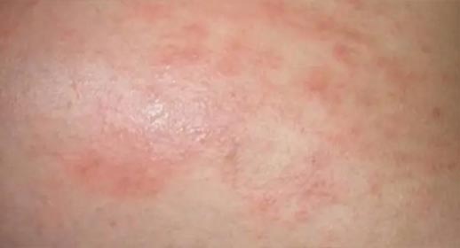 Hyaluronic Acid Anti-Allergy Essence